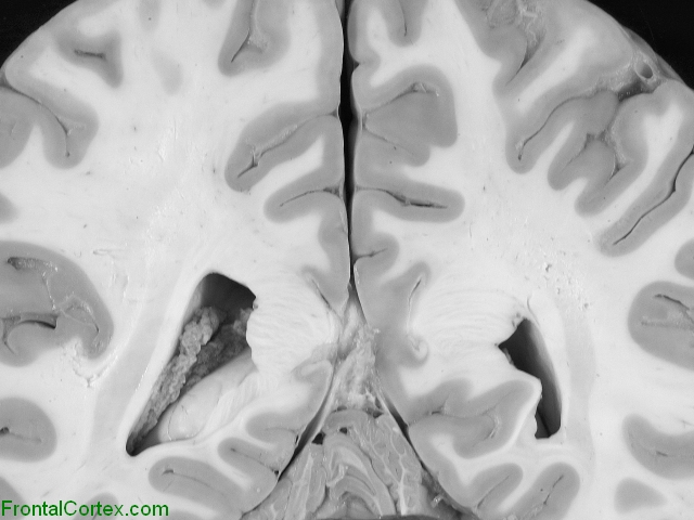 Parietal Coronal